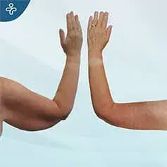 Arm reduction before and after