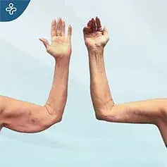 Arm tuck before and after