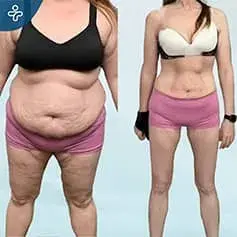 Bariatric Surgery Before and After