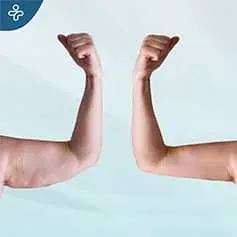 Brachioplasty before and after