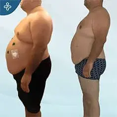Gastric Sleeve Before and After 3 months