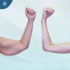 Mini arm lift before and after
