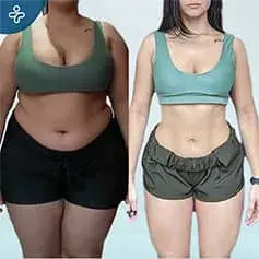 Gastric Bypass Surgery Before and After