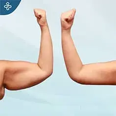Mini lifting de brazos antes y después