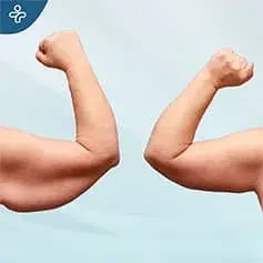 Extended arm lift surgery before and after