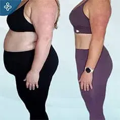 Extraordinary gastric sleeve before and after