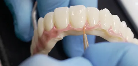 Close-up of All-on-8 dental implants upper arch model held by gloved hands