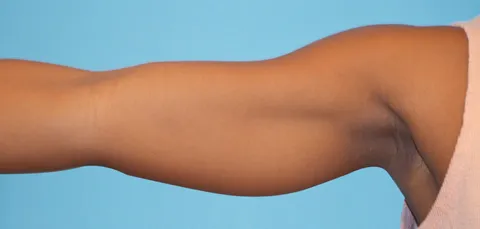 Side view of woman’s arm after arm lift surgery in Turkey, showing tightened and smooth upper arm contour.