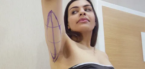 Woman with surgical markings on upper arm preparing for arm lift surgery in Turkey, looking confident before procedure.