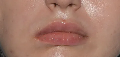 Close-up of woman’s asymmetrical lips before correction treatment in Turkey, showing uneven lip shape and volume.