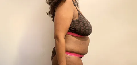 Side view of woman with excess weight and abdominal fat before bariatric surgery in Turkey, wearing sports bra and underwear.