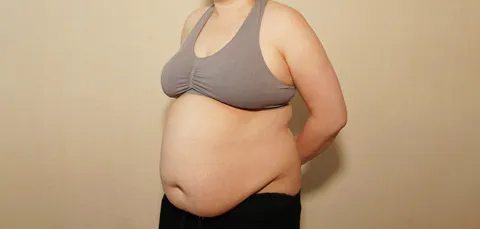 Side view of woman in Turkey before bariatric surgery, showing excess abdominal fat and body contour pre-op.