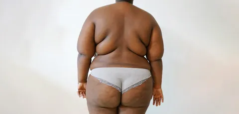 Back view of woman in Turkey before bariatric surgery, showing excess body weight and skin before weight loss procedure.