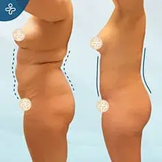Liposuction + Abdominoplasty Before and After