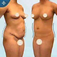Post-Weight Loss Tummy Tuck Before & After