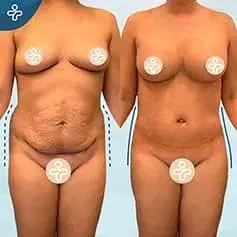 Post-Weight Loss Tummy Tuck Before & After