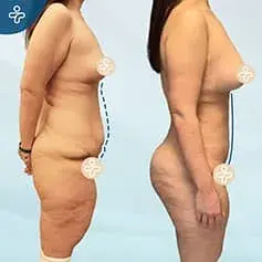 Post-Bariatric Tummy Tuck Before and After