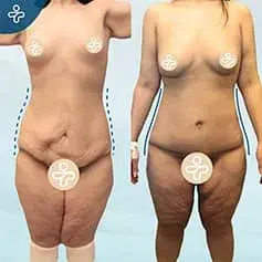 Post-Bariatric Tummy Tuck Before and After