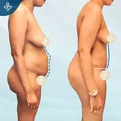 Extended Tummy Tuck Before and After