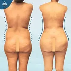 Extended Tummy Tuck Before and After