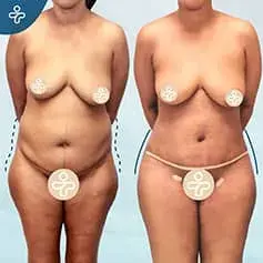 Extended Tummy Tuck Before and After