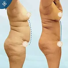Post-Pregnancy Abdominoplasty Before and After