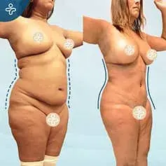 Post-Pregnancy Abdominoplasty Before and After