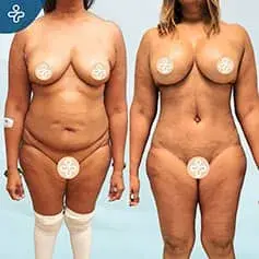Post-Pregnancy Abdominoplasty Before and After