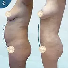 Mini Tummy Tuck Before and After