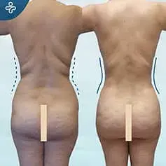 Mini Tummy Tuck Before and After