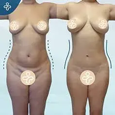 Mini Tummy Tuck Before and After