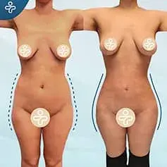 Bubble Butt BBL Before and After