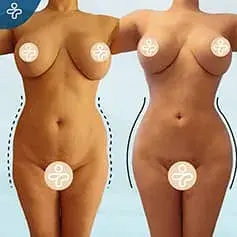 Brazilian Butt Lift Before and After