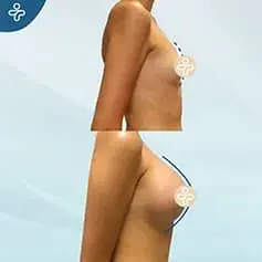 Anatomical Implants Before and After