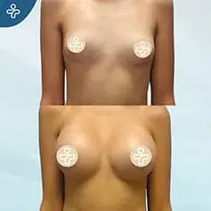 Anatomical Implants Before and After