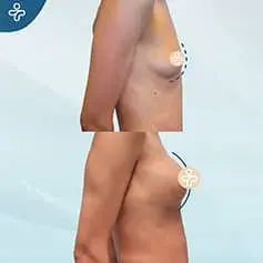 Moderate Projection Before and After
