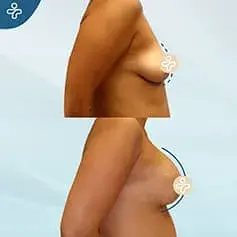 Contoured Implants B&A