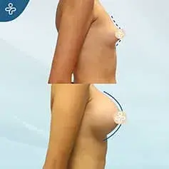 High Projection Anatomical Implants Before After