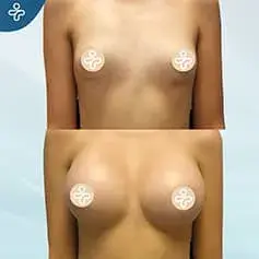 High Projection Anatomical Implants Before After