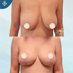 Vertical Breast Uplift Before and After