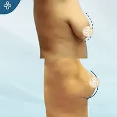 Anchor Breast Lift Before & After