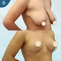 Anchor Breast Lift Before & After