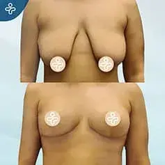Anchor Breast Lift Before & After
