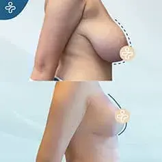 XL Breast Uplift Before and After