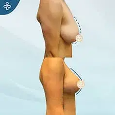 XXL Breast Uplift Before and After