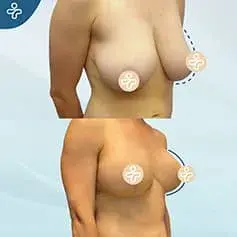 XXL Breast Uplift Before and After