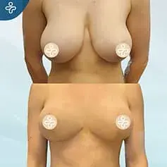 XXL Breast Uplift Before and After