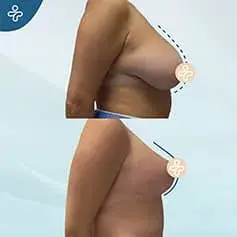 Size+ Mastopexy Before & After