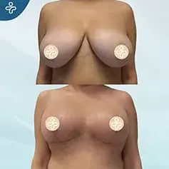 Size+ Mastopexy Before & After