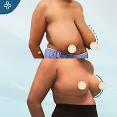XXXL Extended Breast Uplift Before and After